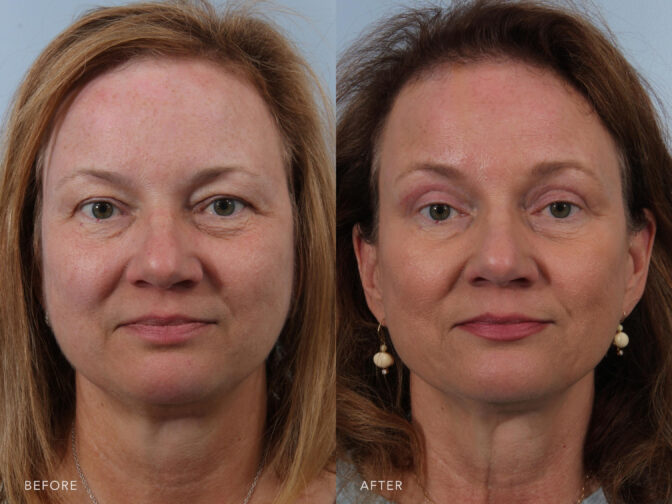 A photos of a woman's face before and after Excision of Excess Upper Eyelid Skin Bilateral procedure. Before photo shows loose baggy eyelids skin while after photo shows a younger and well rested look with the fatty deposits removed in her upper eyes. | Albany, Latham, Saratoga NY, Plastic Surgery