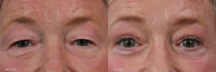 A photo of a woman's upper face before and after the Bilateral Upper and Lower Blepharoplasty and Fat Graft procedure. Before photo shows puffiness and under-eye bags caused by her fat deposits or herniation of the orbital fat, while the after photo shows removed excess skin, giving her eyes a more youthful and rejuvenated appearance. | Albany, Latham, Saratoga NY, Plastic Surgery
