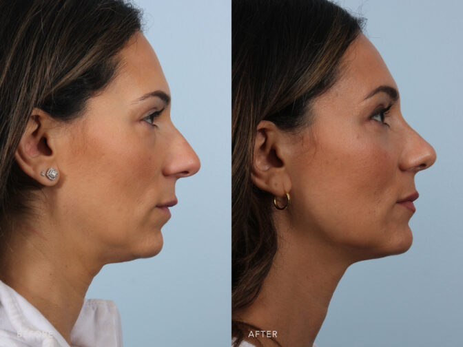 A side-by-side view of a woman's face before and after Endonasal Cosmetic Rhinoplasty procedure. Before photo shows a convex or rounded shape on her nasal bridge. This curvature can disrupt the otherwise smooth line of her nose. While the after photo shows the bridge of her nose that appears smoother and straighter, without the pronounced bump. | Albany, Latham, Saratoga NY, Plastic Surgery