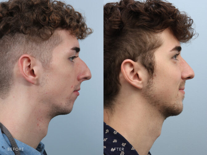 This is a side by side view photos of a man's face before and after Endonasal Cosmetic Rhinoplasty procedure. Before photo shows a nasal airway obstruction caused by his obstructed nasal valves while after photo shows a smoother shaped nose with his removed hump and improved tip definition.| Albany, Latham, Saratoga NY, Plastic Surgery