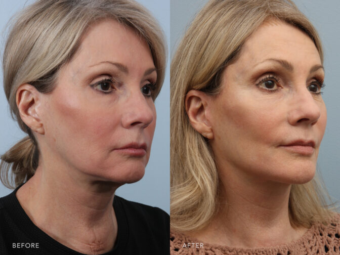 A side-by-side view of a woman's face before and after Deep Plane Lower Face and Neck Lift procedure. Before photo shows loose skin, resulting folds or creases along her jawline and under her chin. While the after photo shows a lifted sagging muscles, resulting a more improved definition of the jawline and a smoother neck contour. | Albany, Latham, Saratoga NY, Plastic Surgery