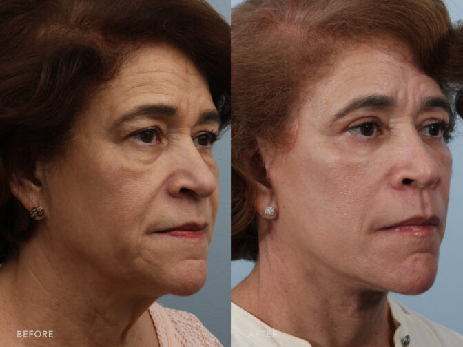 A side-by-side view of a woman's face before and after Facelift procedure. Before photo shows lack of contour between her chin, neck, and jawline, resulting to a less defined due to the sagging skin. While the after photo shows a restored facial contours with her lifted and tightened skin, particularly in areas prone to sagging, such as her cheeks, jowls, and neck. | Albany, Latham, Saratoga NY, Plastic Surgery