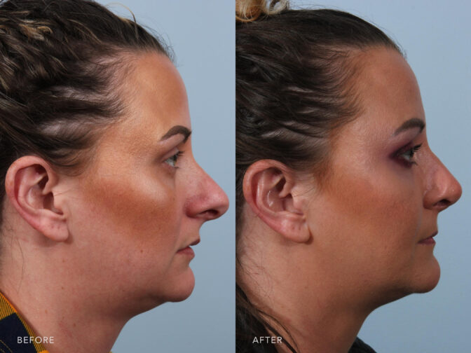 This is a side by side photo of a woman's face before and after Cosmetic Rhinoplasty procedure. Before photo shows a wide or upturned nostrils while after photo shows a straightened bridge and reshaped nose tip.| Albany, Latham, Saratoga NY, Plastic Surgery