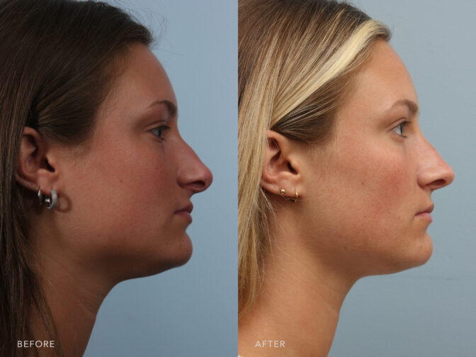 A side-by-side view of a woman before and after Endonasal Rhinoplasty and Septal Reconstruction procedure. Before photo shows deviated septum that causes to decrease her sense of smell, obstructs nasal passages, and impedes proper airflow. While the after photo shows cleared nasal passages, allowing easy airflow, reduced sensation of nasal blockage, and improved her ability to smell and enjoy scents. | Albany, Latham, Saratoga NY, Plastic Surgery