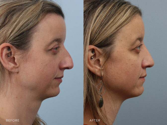 This is a photo of a woman's face before and after Cosmetic Rhinoplasty procedure. Before photo shows an off center nasal septum while after photo shows a modified cartilage of her nose to change its shape or size or even both. | Albany, Latham, Saratoga NY, Plastic Surgery