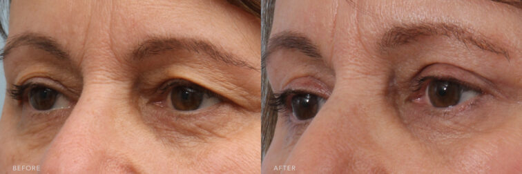 A side-by-side view of a woman's upper face before and after the Bilateral Upper Eyelid Dermatochalasis procedure. Before photo shows excess eyelid skin that is out of the line of her sight, leading to eyestrain and fatigue. The constant strain on the muscles around her eyes contributed to discomfort or tension headaches. While the after photo shows alleviated discomforts, resulting in improved comfort and relief. Her eyes appeared brighter and restored a more alert and rested look. | Albany, Latham, Saratoga NY, Plastic Surgery