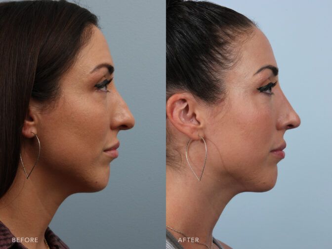 A side-by-side view of a woman before and after a Cosmetic Endonasal Rhinoplasty procedure. Before photo shows a nasal bridge that slopes downward toward her nasal tip and upward toward the area between her eyes, resulting in an uneven profile. While the after photo shows a balanced nasal contour achieving a more harmonious relationship between her nasal bridge and the rest of her nose. | Albany, Latham, Saratoga NY, Plastic Surgery