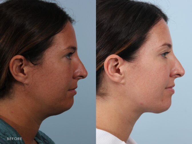 A side-by-side view of a woman before and after the Submental Liposuction procedure. Before photo shows the presence of fat deposits causing noticeable bulges or rolls in her neck area, particularly when her head is in certain positions or during certain facial expressions. While the after photo shows removed excess skin, which helped to tighten her facial muscles creating a more defined neck contour. | Albany, Latham, Saratoga NY, Plastic Surgery