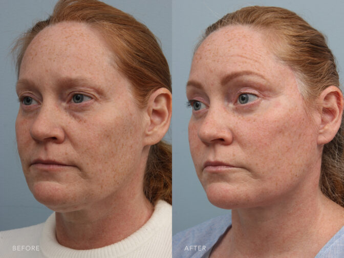 A side-by-side view of a woman's face before and after the Deep Plane Facelift/Lower Lid Blepharoplasty and Fat Grafting procedure. Before the photo shows under-eye bags or puffiness caused by protruding fat pads. While the after photo shows tightened skin and muscles of her lower eyelids resulting in an improved tone and reduced sagging. | Albany, Latham, Saratoga NY, Plastic Surgery