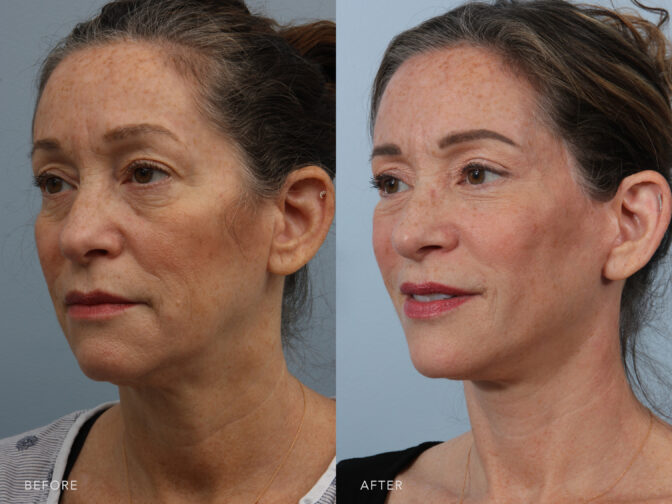 A side-by-side view of a woman's face before and after Deep Plane Lower Face and Neck Lift procedure. Before photo shows folds or creases in her neck area, affecting her overall apperance and contributing to an older or less defined look. While the after photo shows a high skin elasticity, maintaining its firmness and tautness, contributing to a more youthful and revitalized look. | Albany, Latham, Saratoga NY, Plastic Surgery