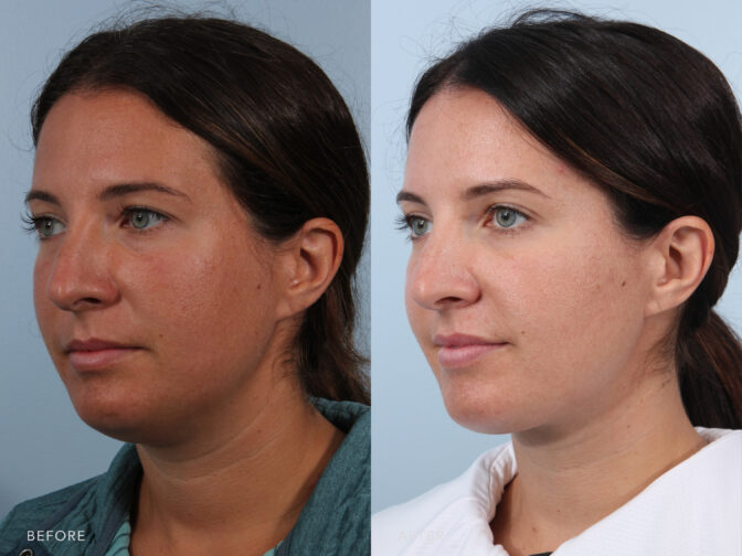 L019 Neck Liposuction Albany, Latham, Saratoga, NY Williams Center