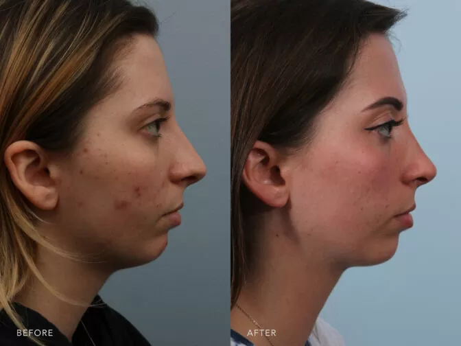 A side-by-side view of a woman's face before and after the Endonasal Septoplasty and Septal Reconstruction procedure. Before photo shows a nasal deformity that changes the nasal shape and appearance. This includes nasal tip drooping, a saddle-shaped deformity of her nasal bridge. While the after photo shows functional improvements in her nasal breathing and aesthetic enhancements to her nasal shape and appearance. | Albany, Latham, Saratoga NY, Plastic Surgery