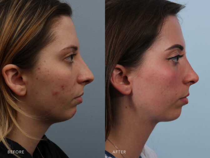 A side-by-side view of a woman's face before and after the Endonasal Septoplasty and Septal Reconstruction procedure. Before photo shows a nasal deformity that changes the nasal shape and appearance. This includes nasal tip drooping, a saddle-shaped deformity of her nasal bridge. While the after photo shows functional improvements in her nasal breathing and aesthetic enhancements to her nasal shape and appearance. | Albany, Latham, Saratoga NY, Plastic Surgery