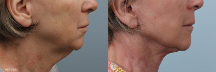 A side-by-side view of a woman before and after the Deep Plane Lower Face and Neck Lift procedure. Before photo shows presence of loose and drooping skin along her jawline, particularly below her cheeks. While the after photo shows a jawline that displays a clear and sharp angle, where the jawbone meets her neck, creating a defined transition between the two areas. | Albany, Latham, Saratoga NY, Plastic Surgery