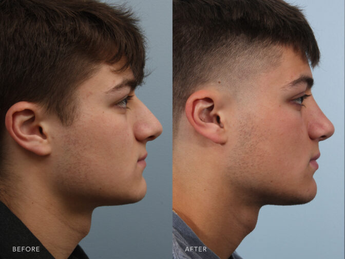 A side-by-side view of a man's face before and after the Endonasal Rhinoplasty procedure. Before photo shows his misaligned nose, leading to breathing problems due to obstruction of one or both of his nasal passages. While the after photo shows an aligned nose that allows proper airflow through both nasal passages without any significant breathing difficulties. | Albany, Latham, Saratoga NY, Plastic Surgery