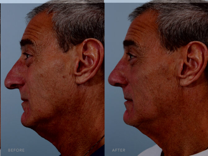 A side-by-side view of a man's face before and after Endonasal Cosmetic Rhinoplasty procedure. Before photo shows a tapered tip, where his nasal tip gradually narrows as it extends from the nasal bridge, forming a pronounced and well-defined point. While the after photo shows a smooth contour. His nasal bridge, dorsum, and the nasal tip follow a continuous straight line without noticeable bumps, humps, or depressions. | Albany, Latham, Saratoga NY, Plastic Surgery 