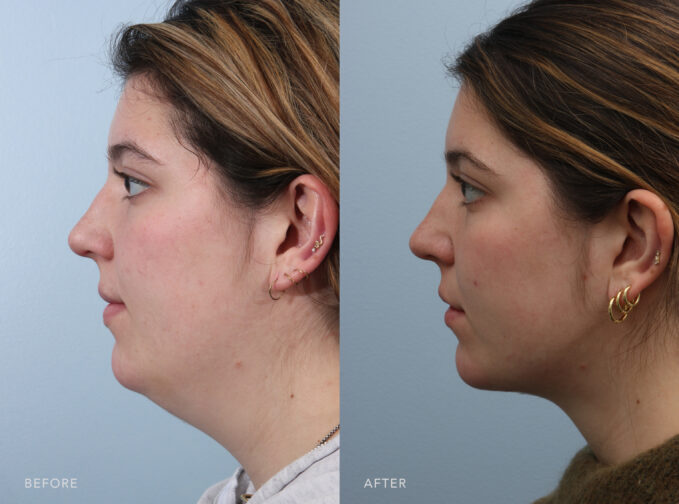 A side-by-side view of a woman before and after the Submental Liposuction and Anterior Platysmaplasty procedure. Before photo shows loose or drooping skin in the lower part of her face, specifically around the jawline and the area just below her cheeks. While the after photo shows added volume and contour of her neck. This helped to soften necklines and improved the appearance of her sagging skin. | Albany, Latham, Saratoga NY, Plastic Surgery