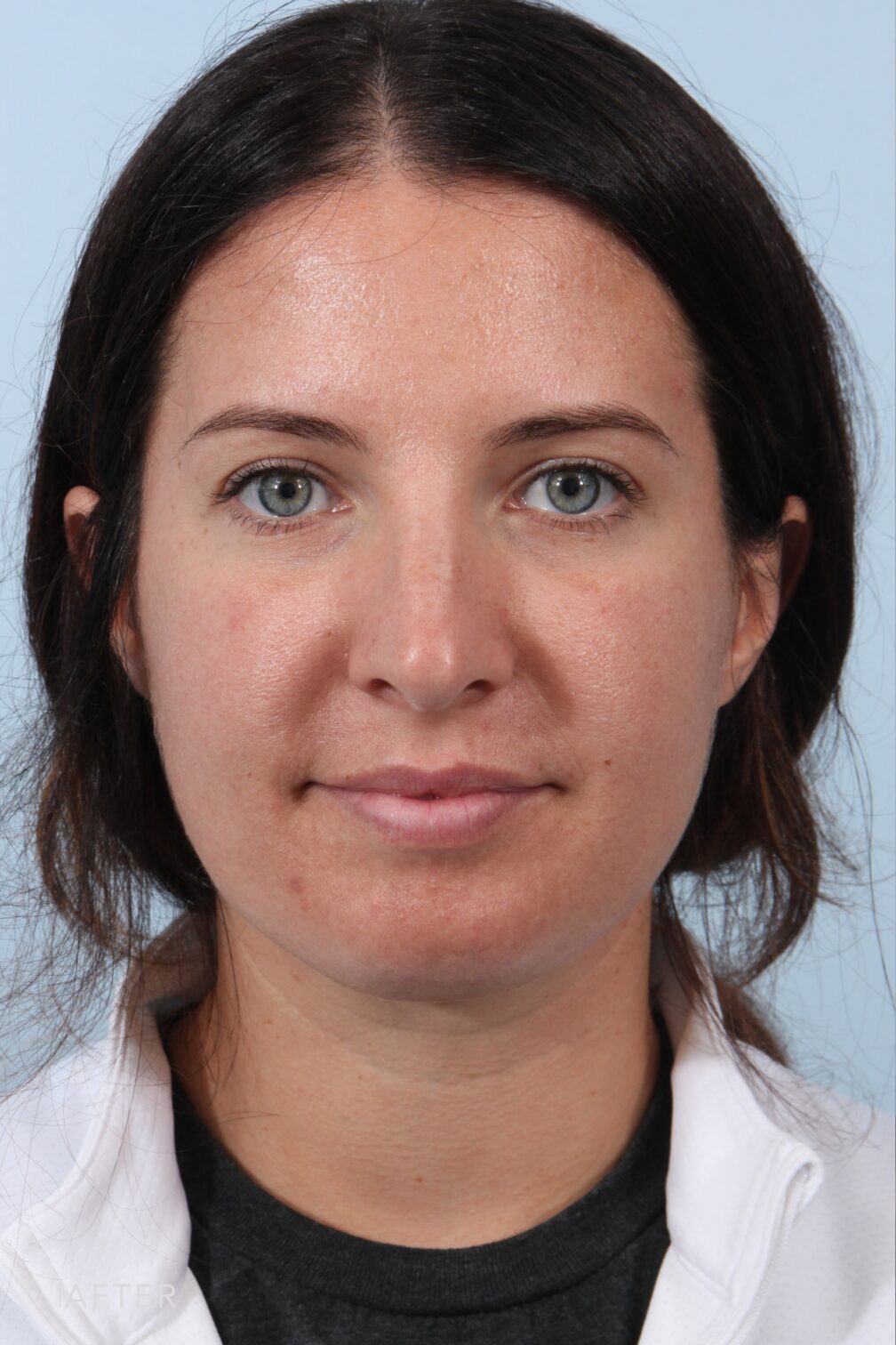 Neck Liposuction Archives Williams Center Williams Center