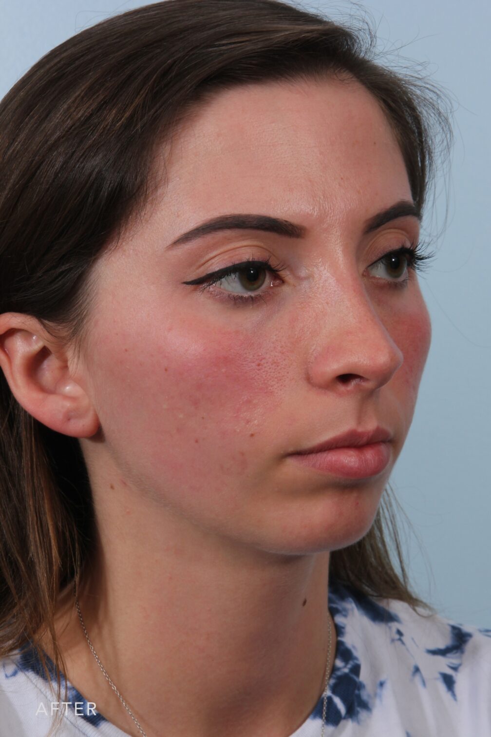 Rhinoplasty & Nasal Reconstruction Pictures | Williams Center Williams ...