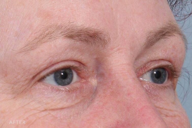 This is a photo of a woman's face with her removed excess skin and reduced bagginess on her upper eyelids. | Albany, Latham, Saratoga NY, MedSpa