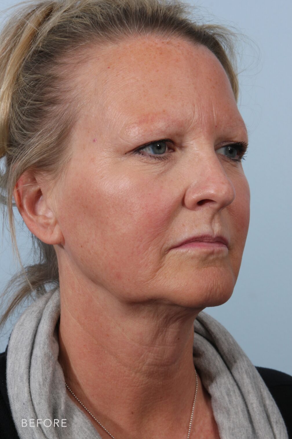 FL130 Deep Plane Facelift Albany, Latham, Saratoga, NY Williams