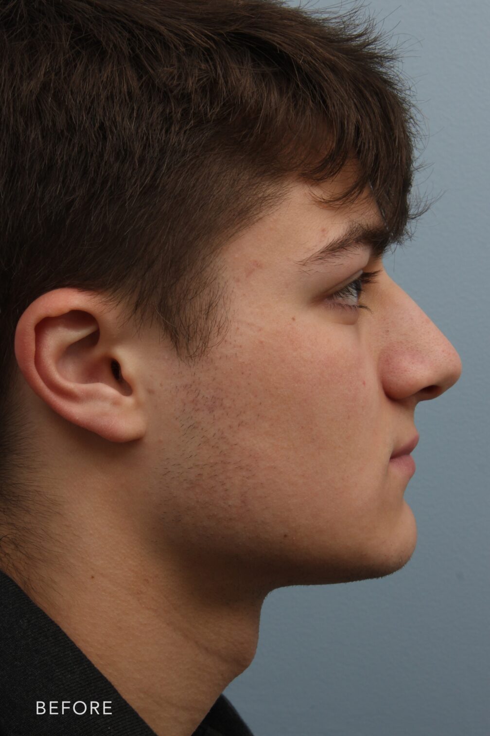 Rhinoplasty & Nasal Reconstruction Pictures | Williams Center Williams ...