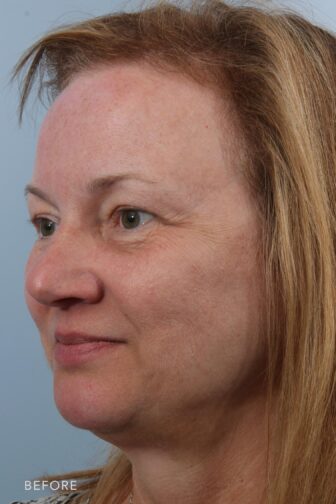 This is a photo of a woman's face with a blonde hair color having skin folds to her upper eyelids that covers the inner corner of her eyes.| Albany, Latham, Saratoga NY, Plastic Surgery
