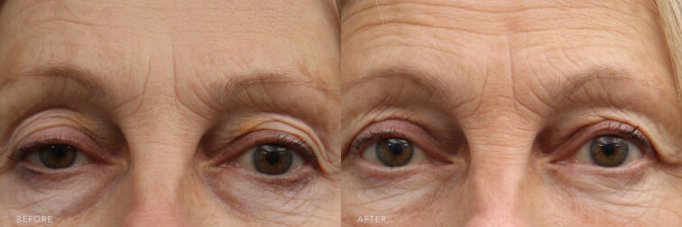 A photo of a woman's upper face before and after Bilateral Transconjunctival Blepharoplasty procedure. Before photo shows pockets of protruding or swollen tissue that formed between her lower eyelids and the cheek, creating a bulging appearance and giving her eyes a tired, aged, or even perpetually sleepy look. While the after photo shows a repositioned excess fats, creating a smoother, more even contour between her lower eyelid and the cheek. Maintaining a natural volume while eliminating the appearance of under-eye bags. | Albany, Latham, Saratoga NY, Plastic Surgery
