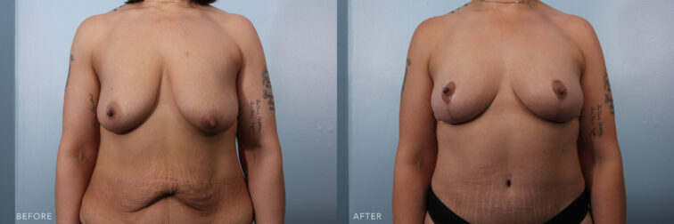 A photo of a woman's upper body before and after the Bilateral Mastopexy procedure. Before photo shows a pronounced sagging or drooping quality, with her breast tissue and skin hanging down from her chest wall. While the after photo shows a beautifully positioned breasts in a firm and upward orientation, showcasing a youthful and naturally perky contour. | Albany, Latham, Saratoga NY, Plastic Surgery