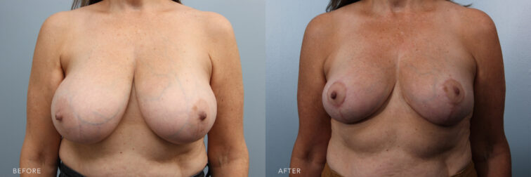 A photo of a woman's upper body before and after Bilateral Micromastia procedure. Before photo shows a poor posture with the weight of her large breasts, leading to spinal problems, skin irritation and rashes underneath her breasts. While the after photo shows a firm, perky, and elevated breasts, leading to a youthful and aesthetically pleasing breast appearance. | Albany, Latham, Saratoga NY, Plastic Surgery