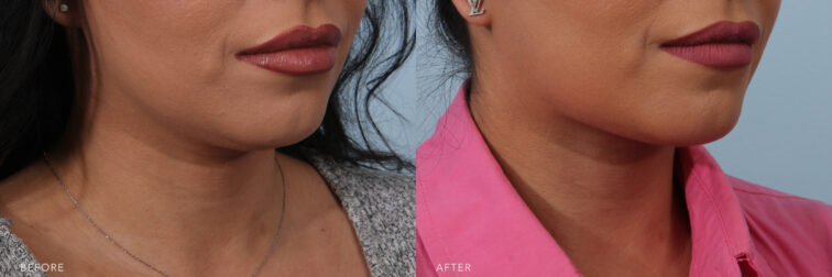 A side-by-side view of a woman's lower face before and after Submental Liposuction procedure. Before photo shows excess fat and skin below her chin and jawline, contributing to the appearance of a double chin. While the after photo shows smooth neck skin that exhibits an even and uniform texture, without the presence of noticeable bumps, rough patches, or irregularities. | Albany, Latham, Saratoga NY, Plastic Surgery