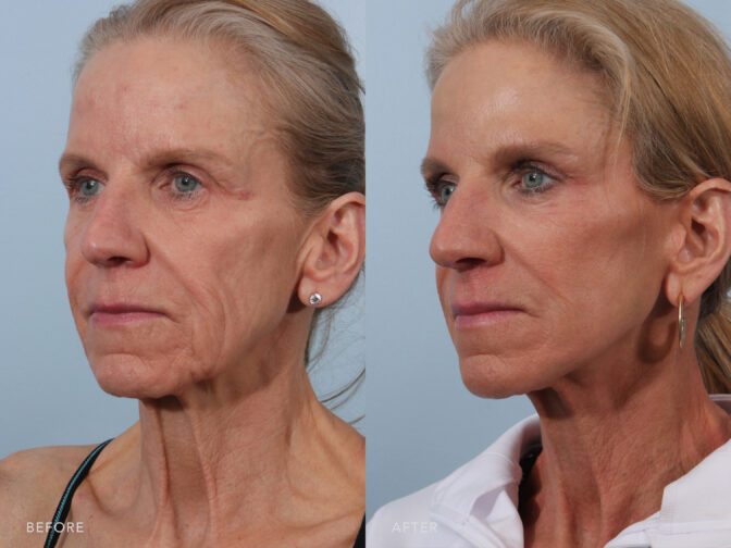 A side-by-side view of a woman's face before and after Deep Plane Lower Face and Neck Lift procedure. Before photo shows wrinkles on her jawline and along the sides of her face, extending from her lower jawbone to the area around the chin. While the after photo exhibits a high degree of elasticity, allowing it to snap back into place when gently pulled or stretched. | Albany, Latham, Saratoga NY, Plastic Surgery