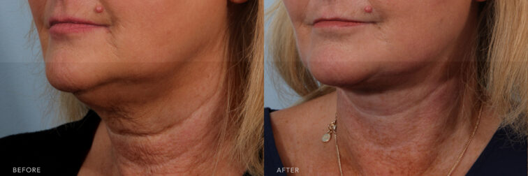A side-by-side view of a woman's lower face before and after Deep Plane Lower Face and Neck Lift procedure. Before photo shows wrinkles in her neck and accompanied by loose or sagging skin, contributing to an aged appearance. While the after photo shows angular and well-pronounced neck, creating a chiseled and aesthetically pleasing look. | Albany, Latham, Saratoga NY, Plastic Surgery