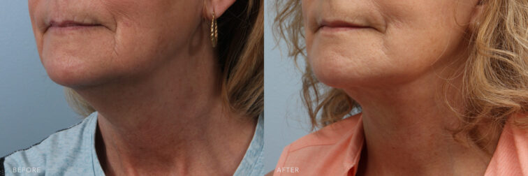A side-by-side view of a woman's lower face before and after Deep Plane Lower Face and Neck Lift procedure. Before photo shows a bump that extends outward from the natural contour of her jawline, causing a noticeable protrusion along her jawline. While the after photo shows a well-defined jawline, highlighting the clarity of her jaw's outline and enhancing the overall facial symmetry and attractiveness. | Albany, Latham, Saratoga NY, Plastic Surgery