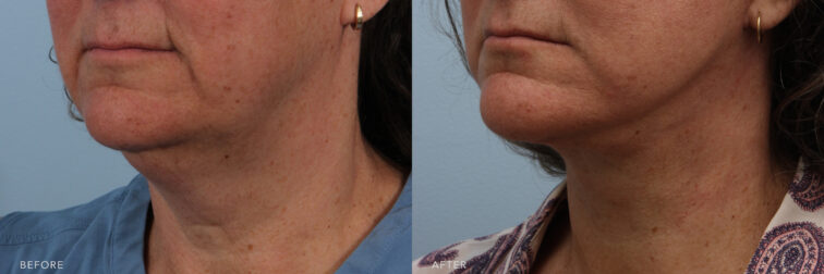 A side-by-side view of a woman's lower face before and after Deep Plane Lower Face and Neck Lift procedure. Before photo shows a shapeless neck that blended into her jawline without a distinct separation from the jaw to her neck. While the after photo shows a clear and well-defined contours, including a distinct jawline and a graceful curve down to her collarbone. | Albany, Latham, Saratoga NY, Plastic Surgery