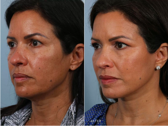 Facelift patient showing her six months post-operative results