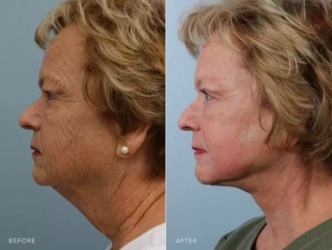 Before and after pictures showing a patient who has undergone a deep plane facelift, upper/lower blepharoplasty, 35% customized TCA peel, and fat transfers to her mid-face