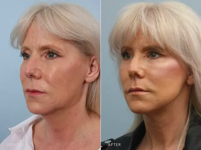Before and after pictures of a patient, who is now six weeks into her recovery from a deep plane facelift.