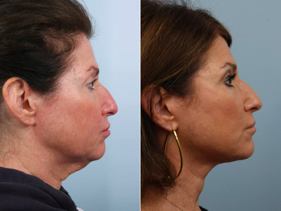Patient before and after after having deep plane facelift, which addressed not only the mid-face and lower eyelid complex, but also addressed the area along the smile lines, jawline and especially the neck.