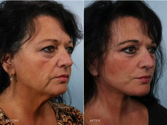 Patient showing before and after photos four weeks out from her deep plane facelift.