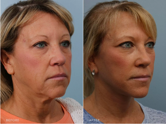 Oblique view of facelift patient showcasing her before and after results