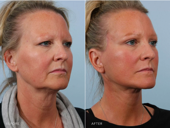 Oblique view of patient showcasing results of facelift and upper blepharoplasty