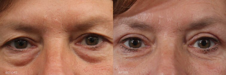 A photo of a woman's upper face before and after the Excision of Excess Upper Eyelid Skin procedure. Before photo shows a lowered eyelid position due to the excess skin on her upper eyelid, contributing to the drooping appearance. While the after photo shows a tighter upper eyelid skin with minimal or no signs of sagging, giving her eyes a more youthful and vibrant appearance. | Albany, Latham, Saratoga NY, Plastic Surgery