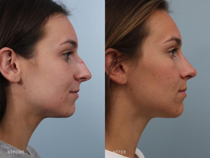 A side-by-side view of a woman's face before and after Endonasal Cosmetic Rhinoplasty procedure. Before photo shows a deviated nasal bridge, where the bridge of her nose appeared curved or bent to one side, creating an irregular profile. While the after photo shows an equal size and shape of her nostrils, having same height on both sides of her nose. | Albany, Latham, Saratoga NY, Plastic Surgery
