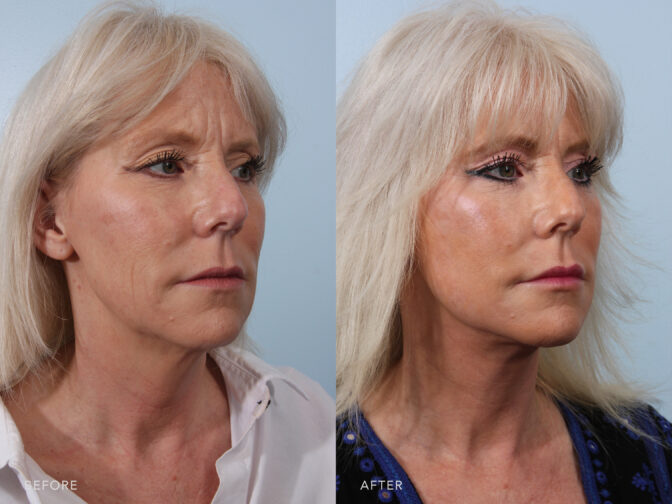 A side-by-side view of a woman's face before and after Deep Plane Lower Face and Neck Lift procedure. Before photo shows a rough or less smooth skin texture, with the development of age spots, sunspots, and other skin imperfections. While the after photo shows a plump and full cheeks with a natural fullnes that contributes to a youthful contour. | Albany, Latham, Saratoga NY, Plastic Surgery