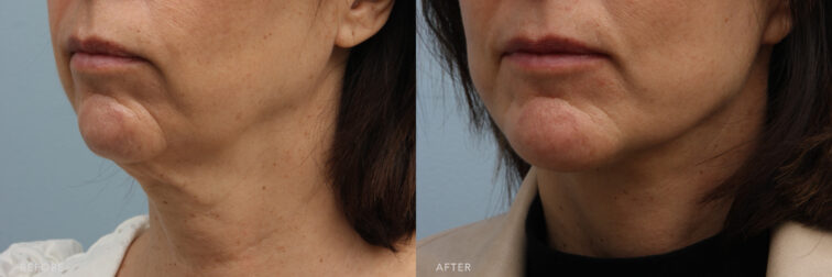 A side-by-side view of a woman's lower face before and after Deep Plane Lower Face and Neck Lift procedure. Before photo shows a saggy jowls that altered the overall shape of her face, making it appear less youthful and less well-defined. While the after photo shows a well-defined jawline that showcase the underlying muscle tone of her jaw and neck area, particularly the masseter muscles, contributing to a more structured look. | Albany, Latham, Saratoga NY, Plastic Surgery