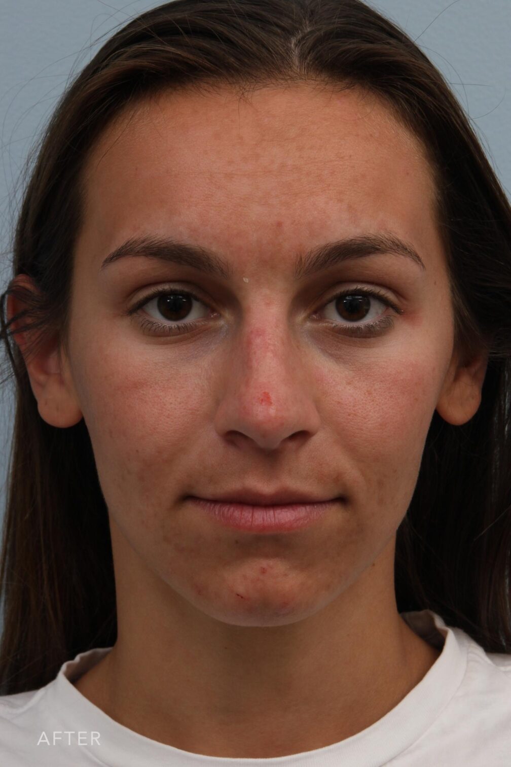 Rhinoplasty & Nasal Reconstruction Pictures | Williams Center Williams ...