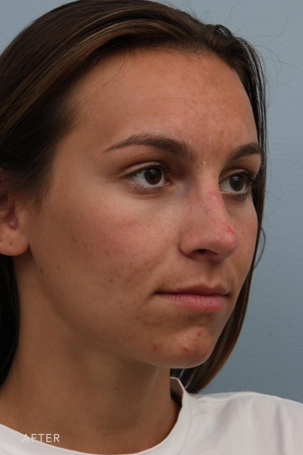 Rhinoplasty & Nasal Reconstruction Pictures | Williams Center Williams ...