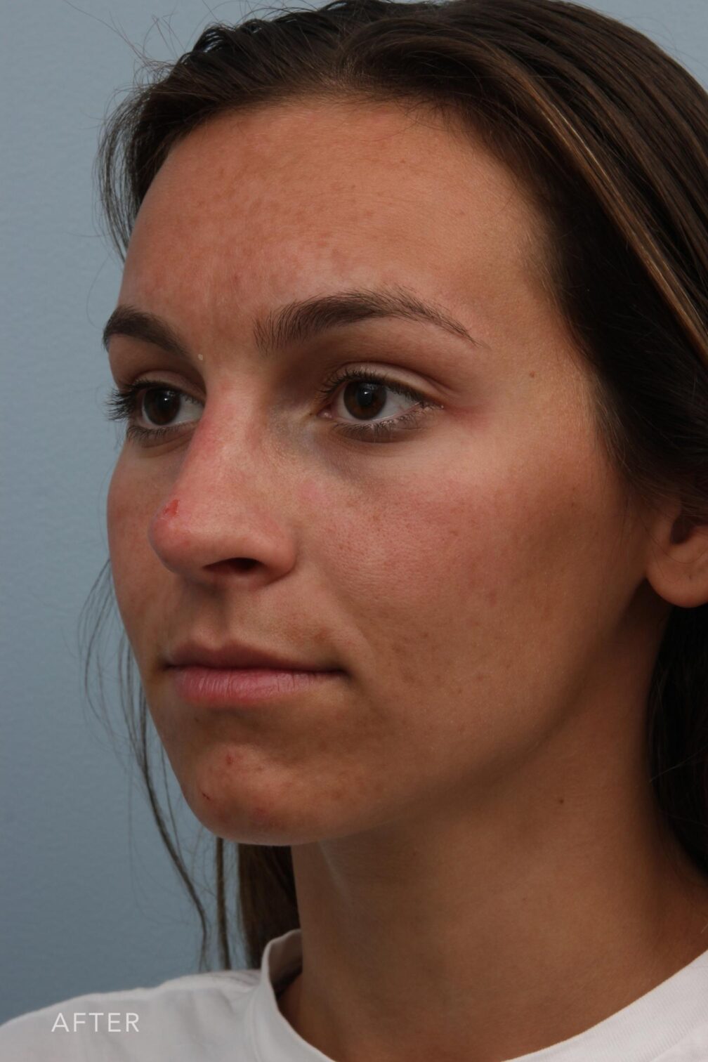 Rhinoplasty & Nasal Reconstruction Pictures | Williams Center Williams ...