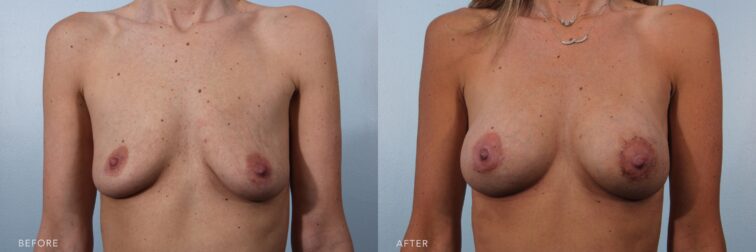 A photo of a woman's upper body before and after the Bilateral Micromastia procedure. Before photo shows breasts that lack youthful firmness, resulting in a softer or less taut appearance, while the after photo shows firm breasts and a well-rounded shape, with a noticeable volume and projection. | Albany, Latham, Saratoga NY, Plastic Surgery